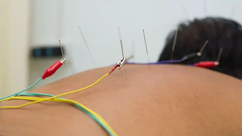 dry needling for lower back pain