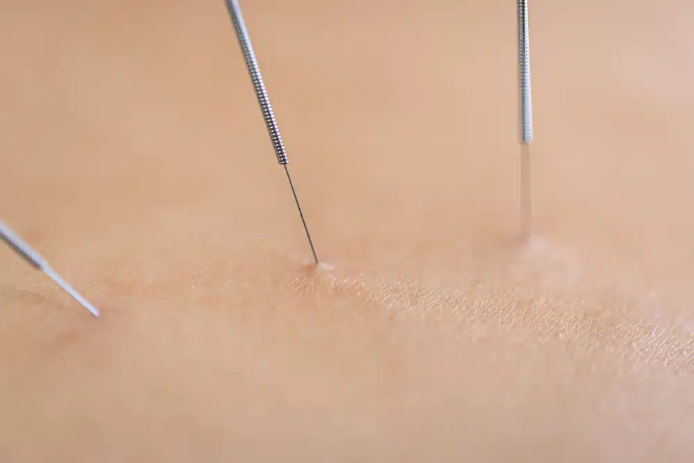 Dry needling in katy