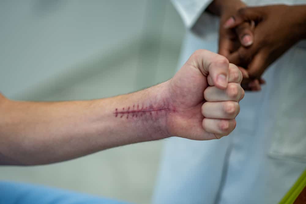 Scar on the skin of the man's arm after a surgery